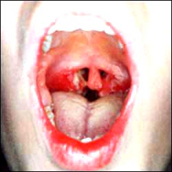 tonsillitis_4-1s.jpg