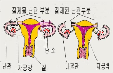 tuballigation-1s.jpg