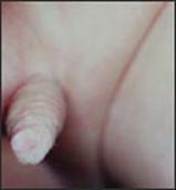 penis-uncircumcised-1s.jpg