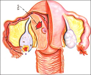 injplantation-endometrium-1s.jpg