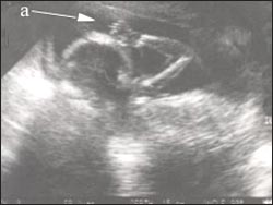 fetus-ultrasound-finger-sucking-2s.jpg