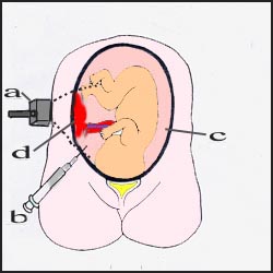 amniocentesis-3s.jpg