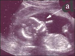 fetus-ultrasound-finger-sucking-1s.jpg