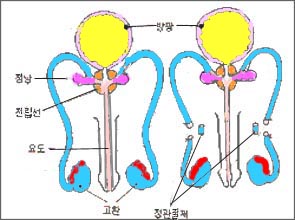 vasectomy-1-1s.jpg