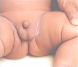 uncircumcised-penis-1-1s.jpg