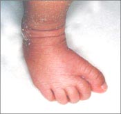 ankle-foot-1-1s.jpg