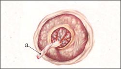 placenta-circumvallata-1-1s.jpg