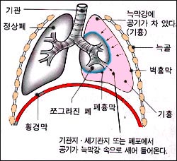 anatomy_pneumothorax_-2s.jpg